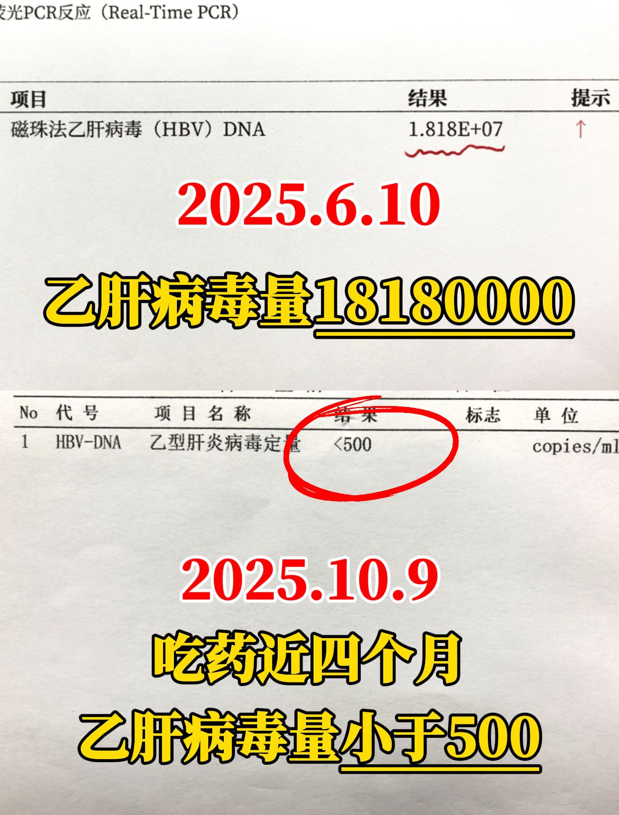 43 岁的山东病友来复查，拿着报告跟我笑：“教授，您看！病毒量终于下来...