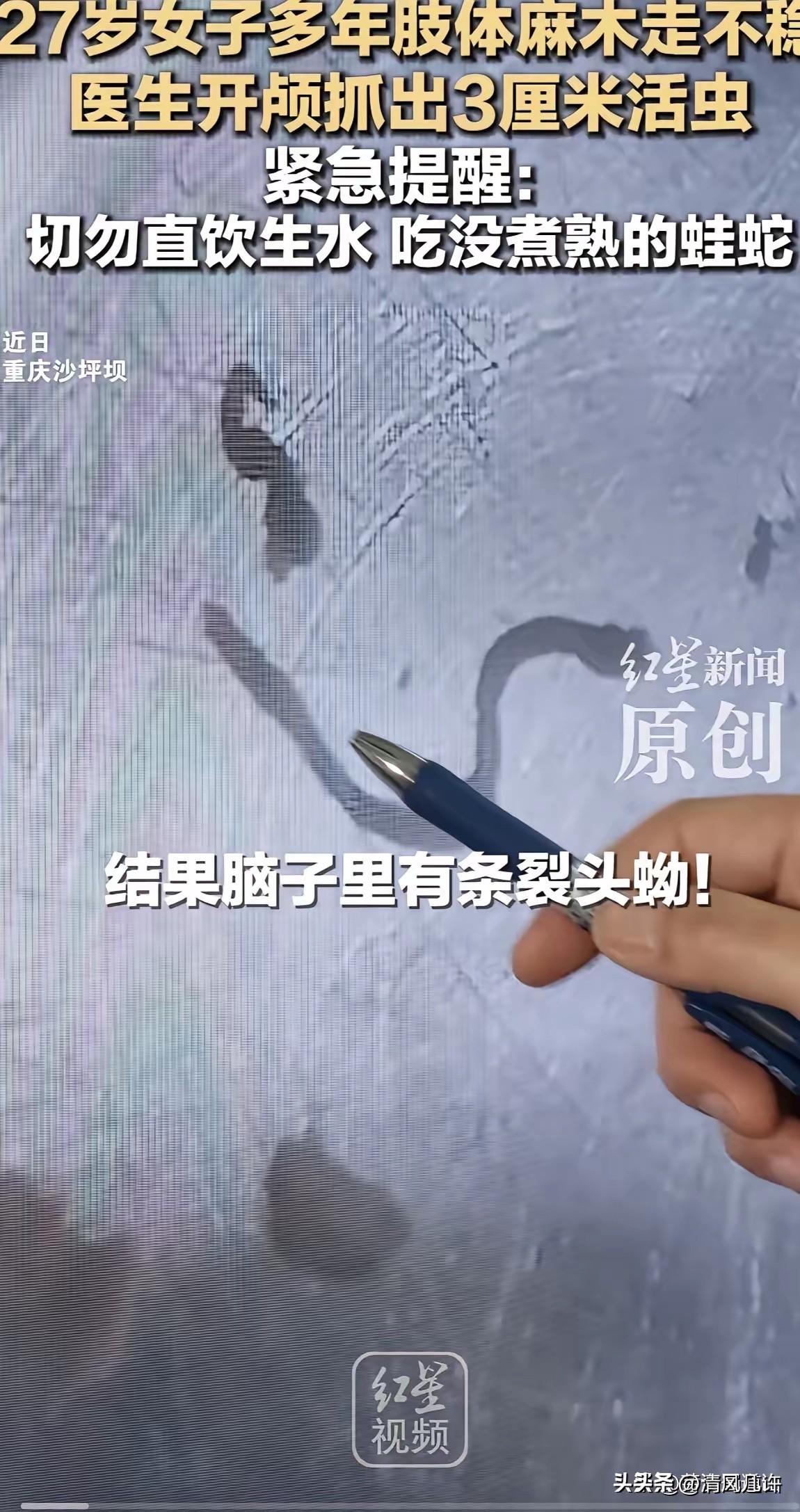 重庆一女子，头疼了5年。
​跑遍大医院，医生都说可能是脑瘤。
​结果开颅后，取出