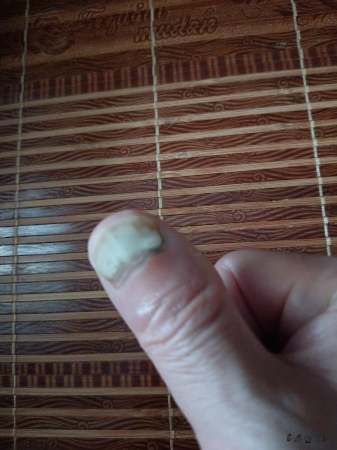 灰指甲的真相灰指甲是真菌在啃你的指甲。穿闷鞋、脚出汗、剪破皮就能得，一个传染俩，