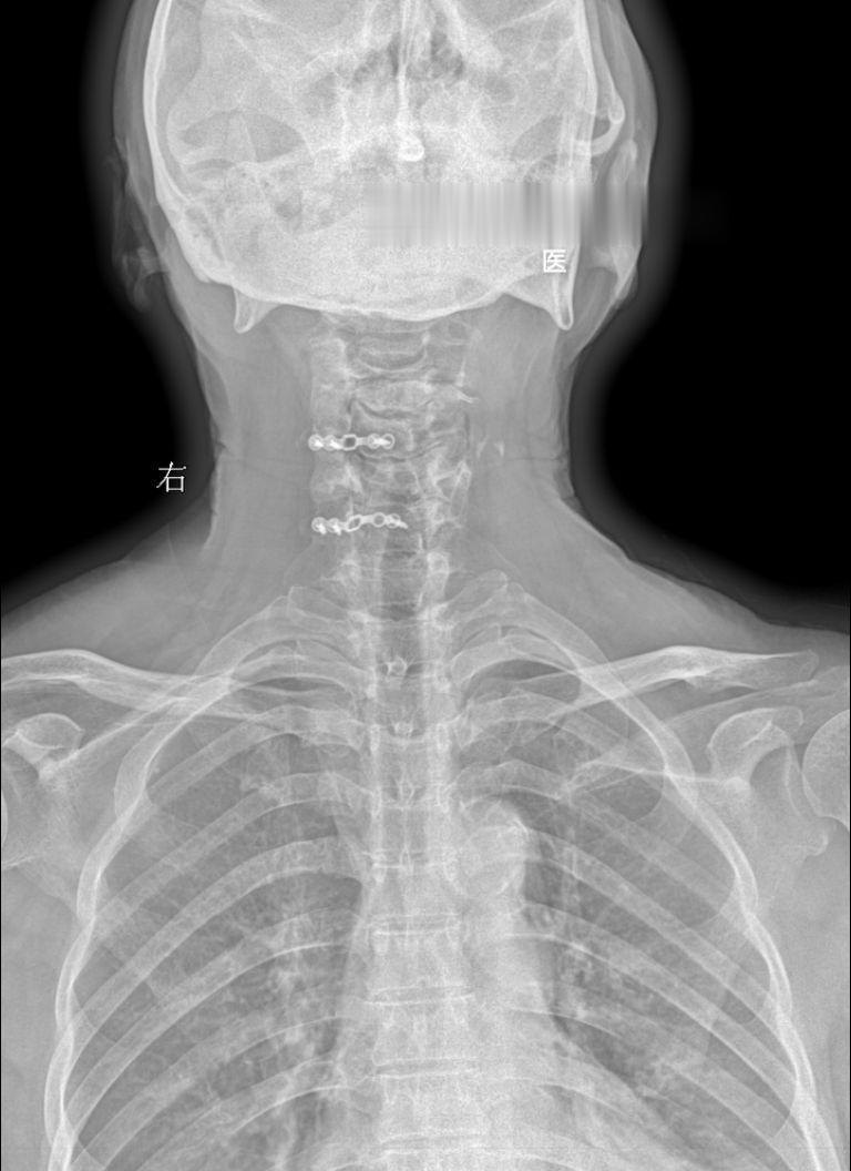 体征:车祸术后两年，颈椎疼痛就诊