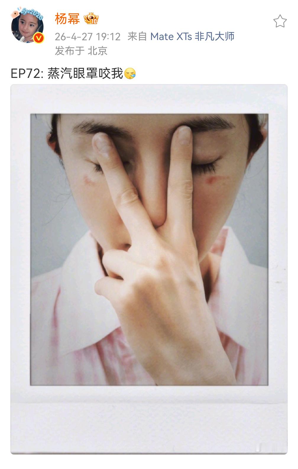 杨幂脸被蒸汽眼罩烫伤了 可恶的蒸汽眼罩，把我的杨幂给烫伤了。心疼我的大幂幂！大家