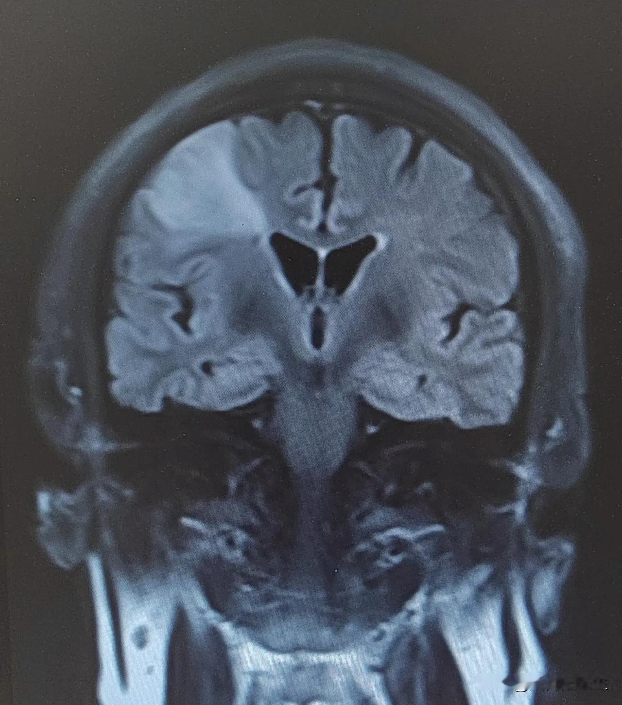 脑梗死还是胶质瘤？
诊断疾病，有时候还要不厌其烦地追问患者的病史，患者的发病过程