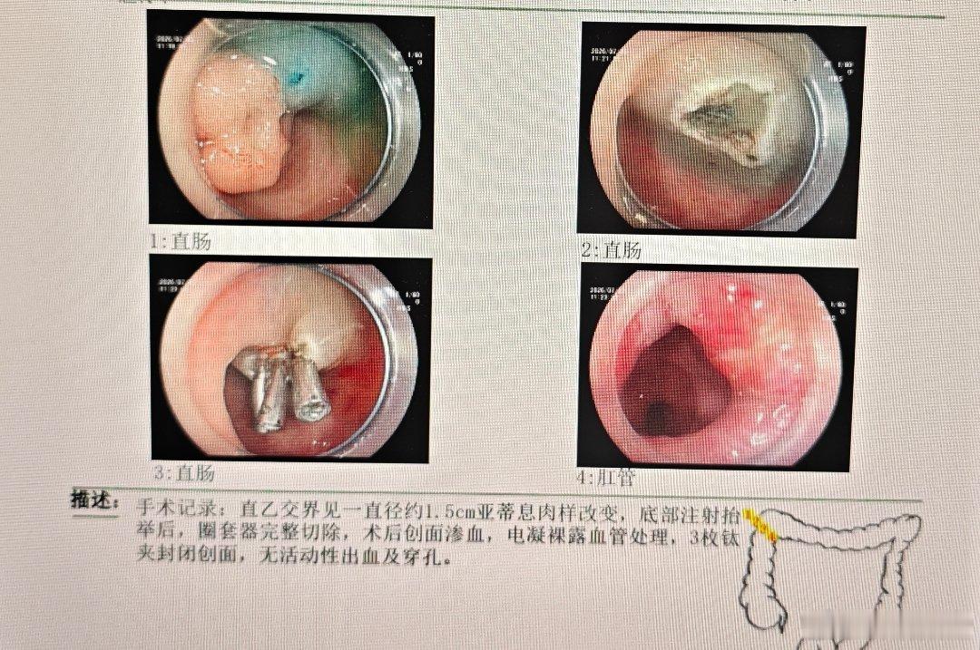 过去处理创面总担心点电凝多了，搞穿孔了，电凝处理血管+钛夹封闭，基本上还是安全的