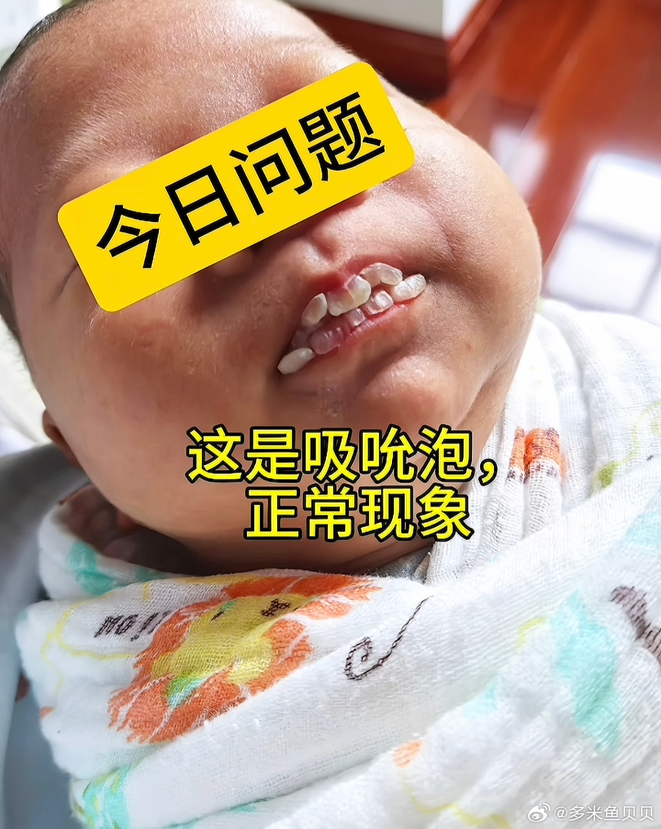 吸吮泡也叫“皮珠”，1吸吮泡是新生儿常见现象，因吸吮摩擦嘴唇粘膜，使局部角质层堆