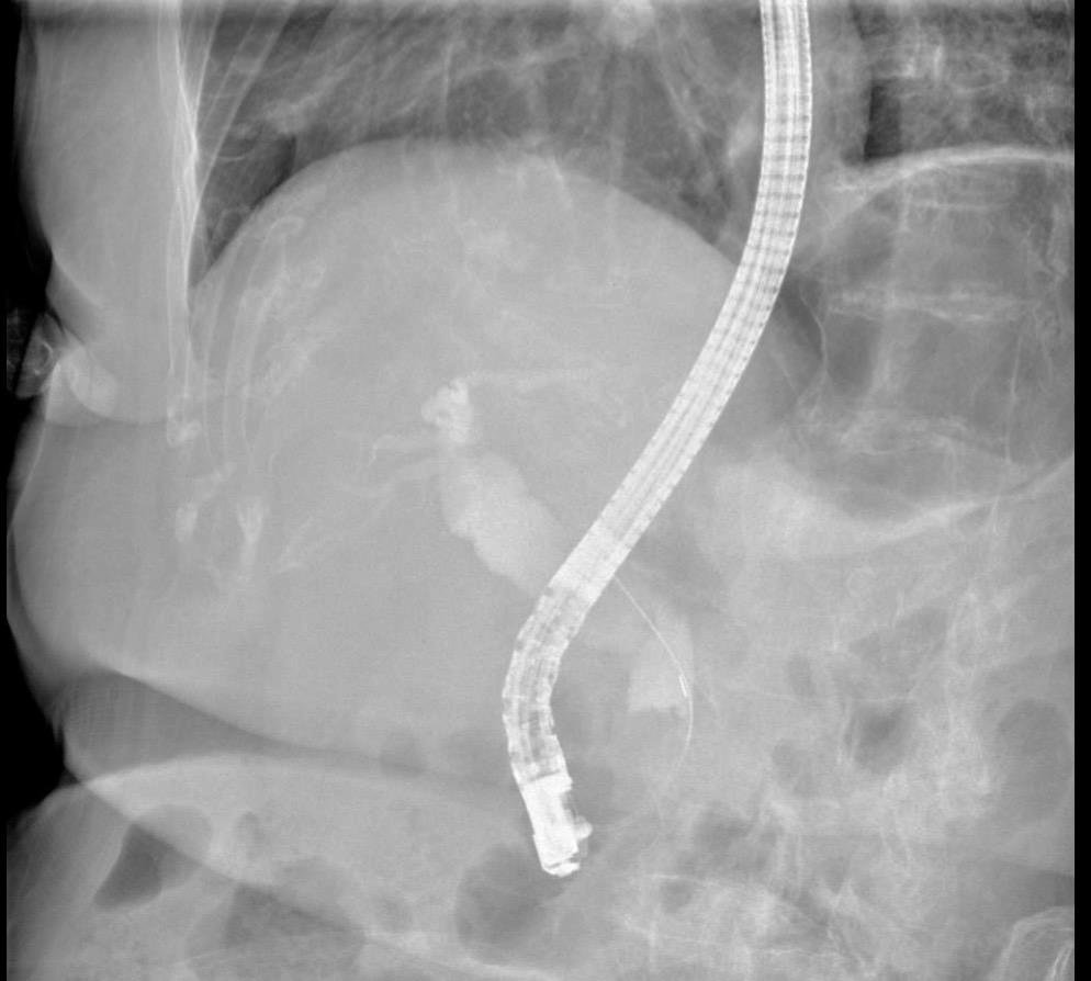 周末胆管结石化脓性胆管炎急诊ERCP.患者胆囊切除术后，这次因胆管结石...