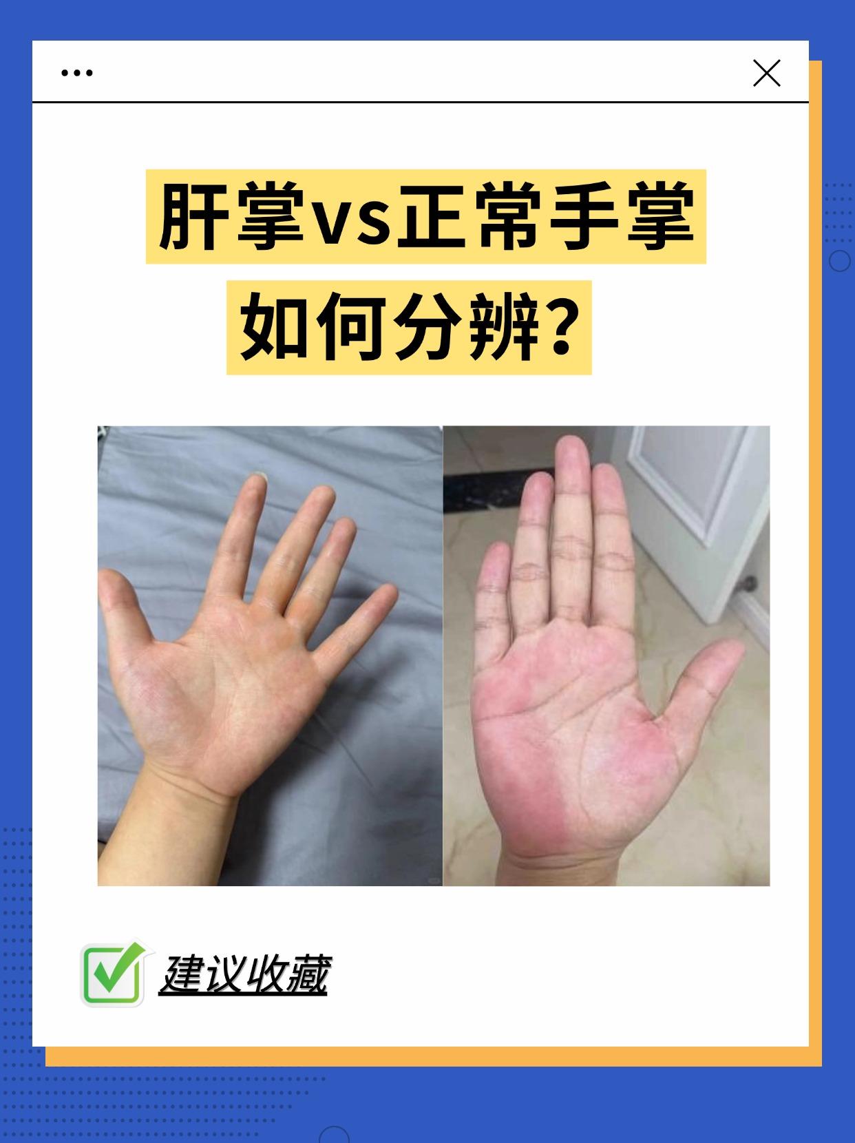 手掌红是肝掌吗?。