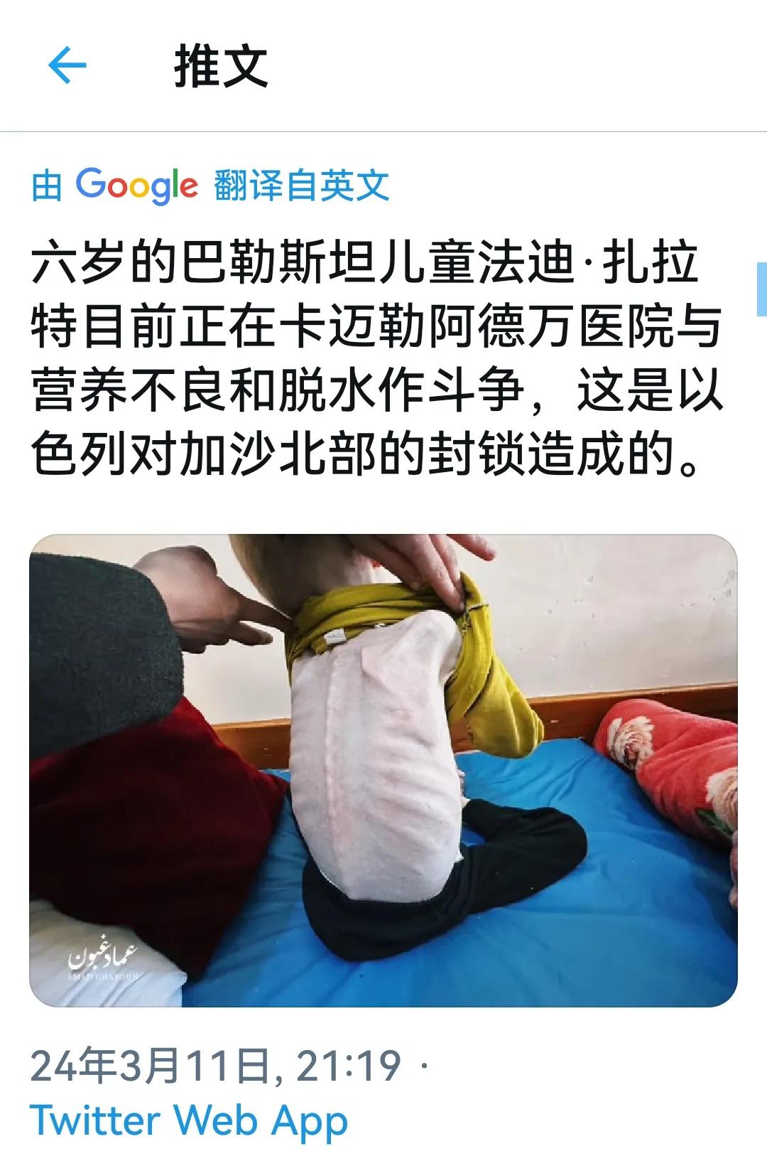 六岁的巴勒斯坦儿童法迪·扎拉特，目前正在卡迈勒阿德万医院与营养不良和脱水作斗争，