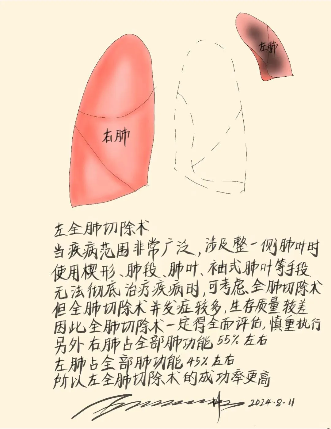 左全肺切除术