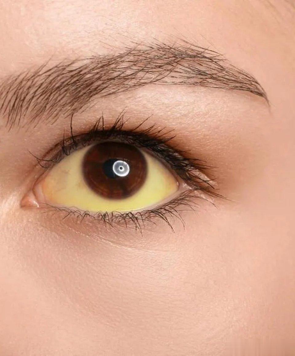 体内有癌，眼睛可知？医生：眼睛若出现这4种迹象，赶快去检查​1. 眼白发黄​眼白