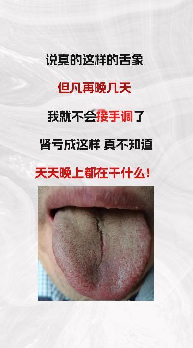 出现这种舌象，但凡在拖几天，我都不会给他调理，肾亏虚的严重，真不知晚上都在干啥#