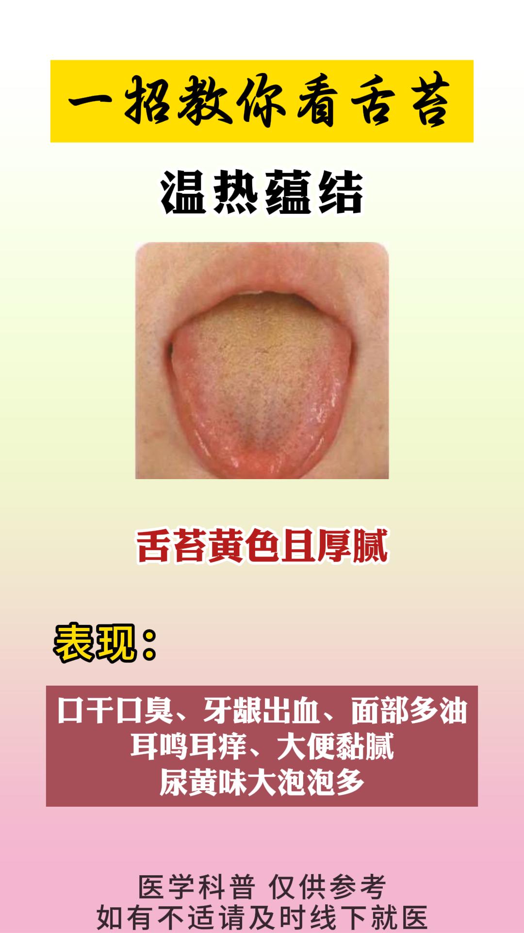 三种门诊上常见的舌苔，你是哪一种？。