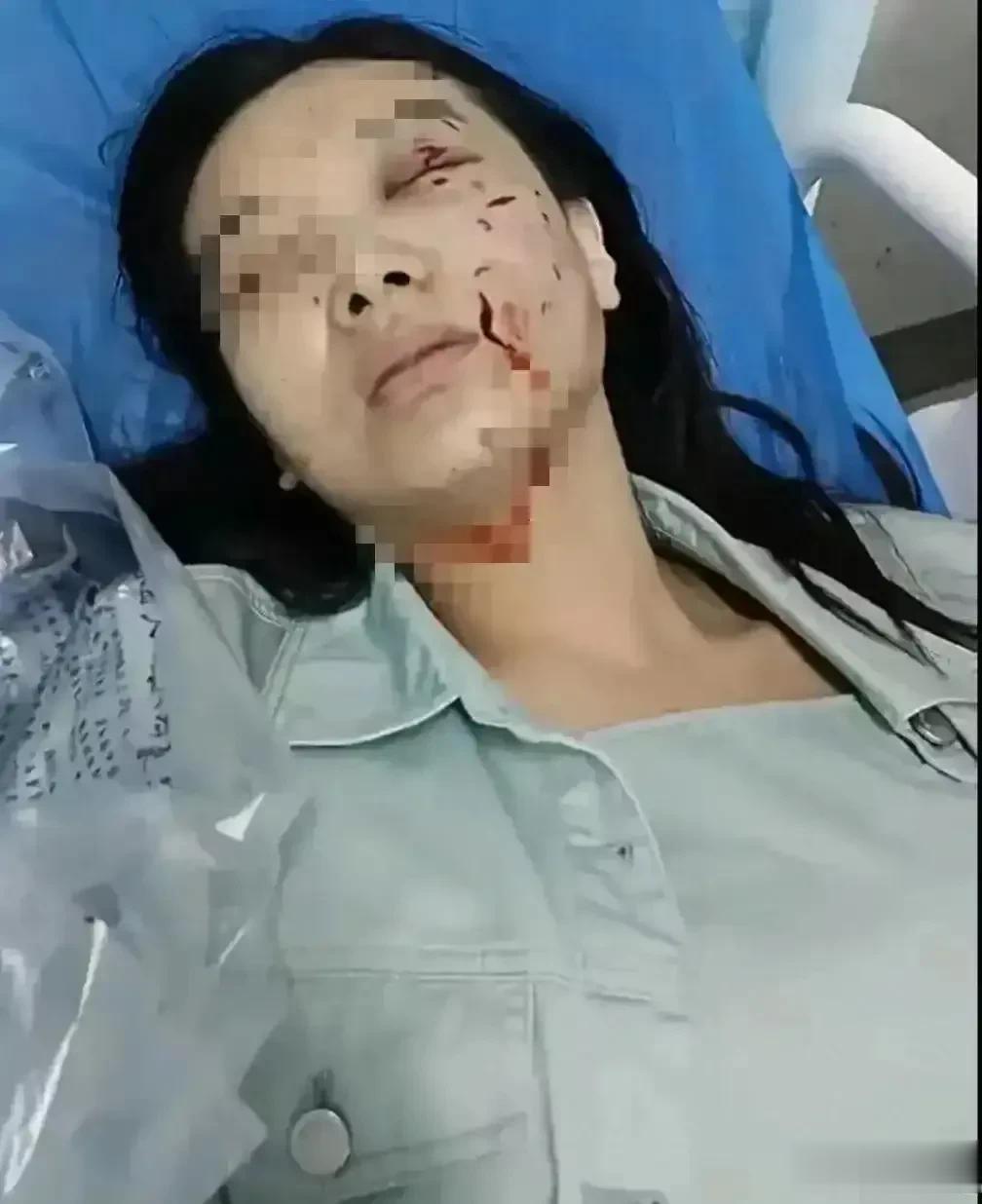 “女子被狗咬”后续更新来了。当事狗已被处理，双方当事人纠纷却陷入僵局。

双方的
