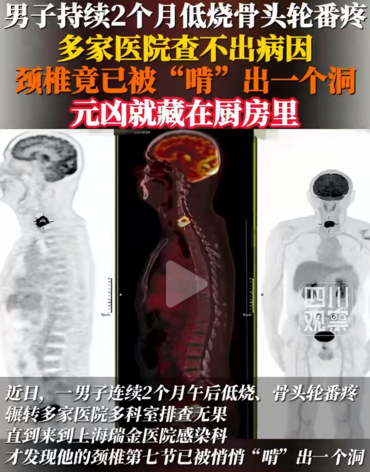 有位男子被怪病缠上两个月，整个人状态越来越差。每天下午准时发低烧，身上骨头轮流疼