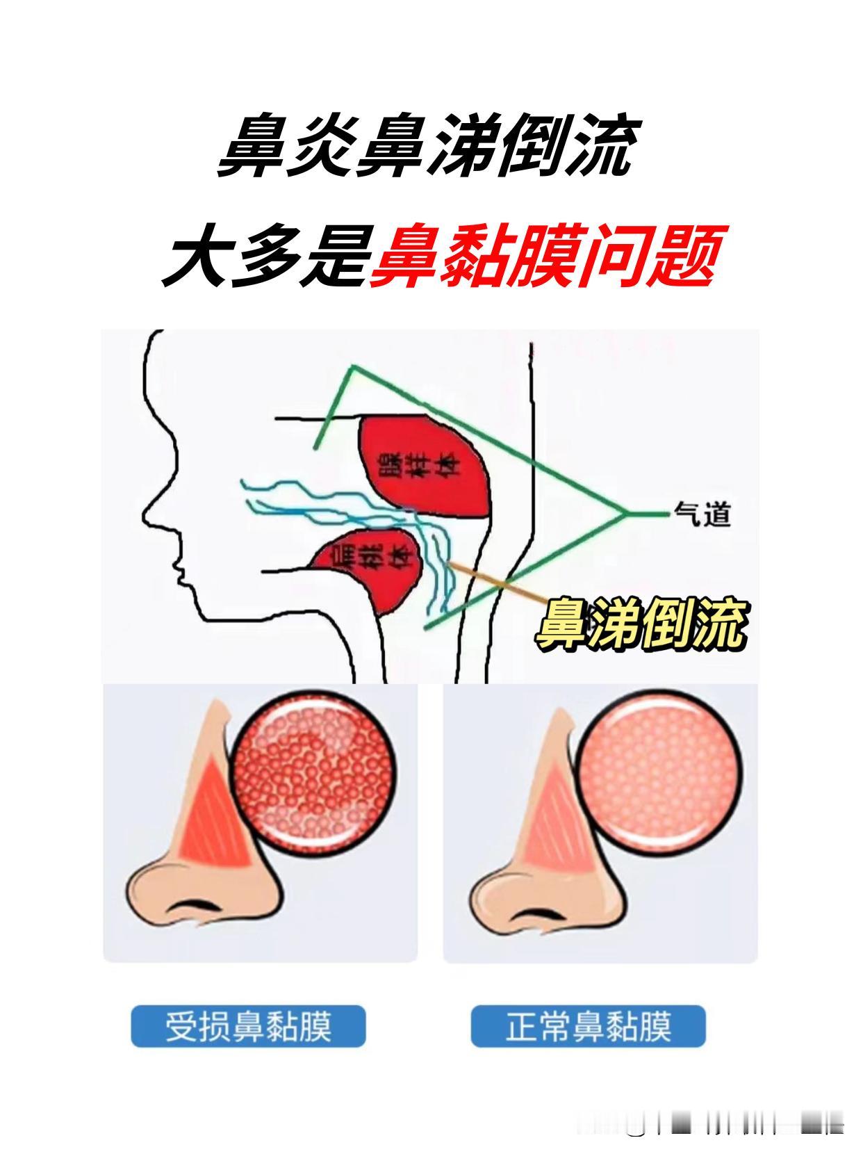 鼻炎鼻涕倒流，大多可能是鼻粘膜问题导致的。

如果你能早点搞清楚其中的原因呢，我