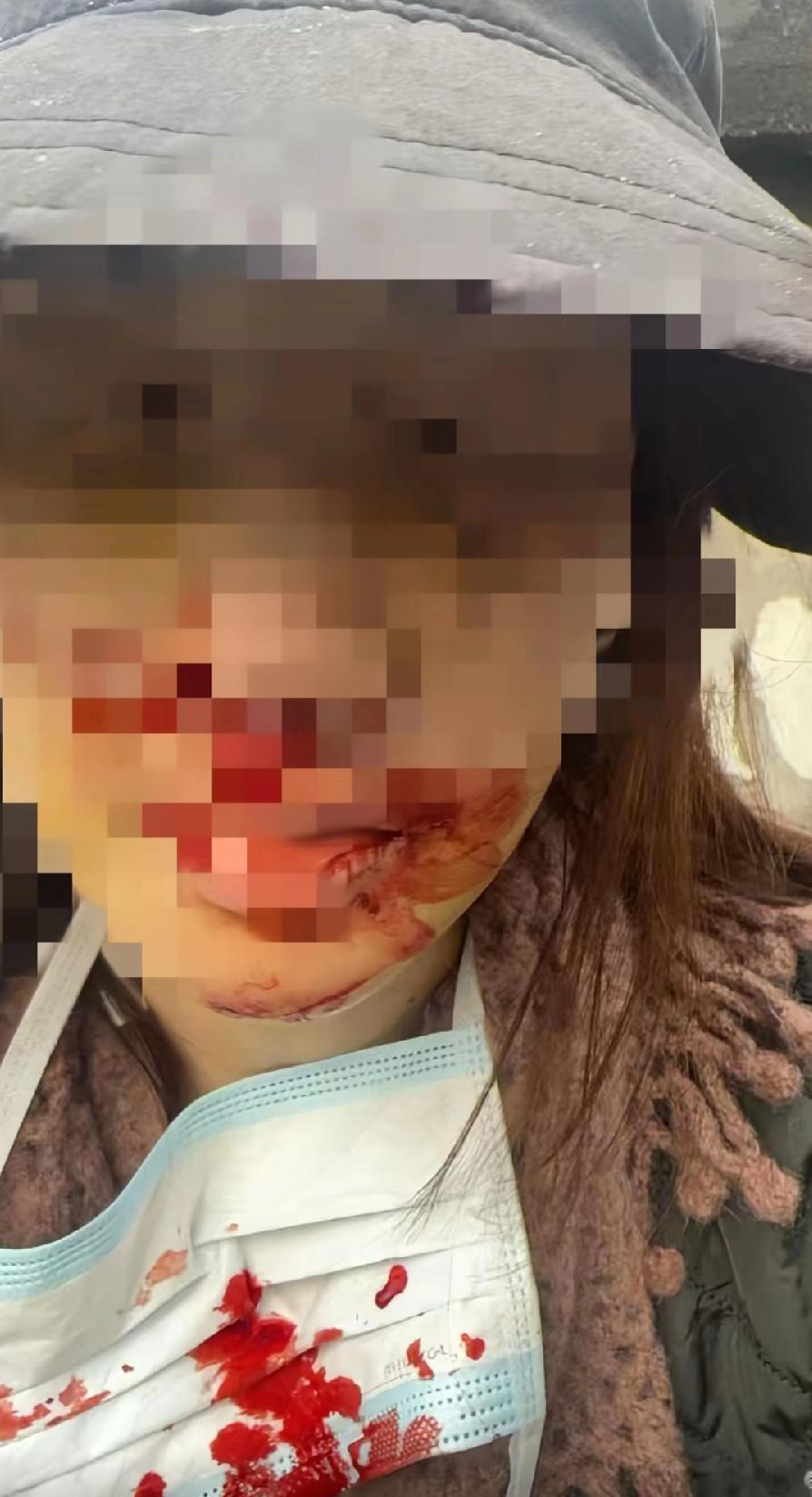 金晨车祸受伤照片，伤得真不轻，虽然打了码，嘴上、鼻子周围全是血，口罩上面也都是鲜