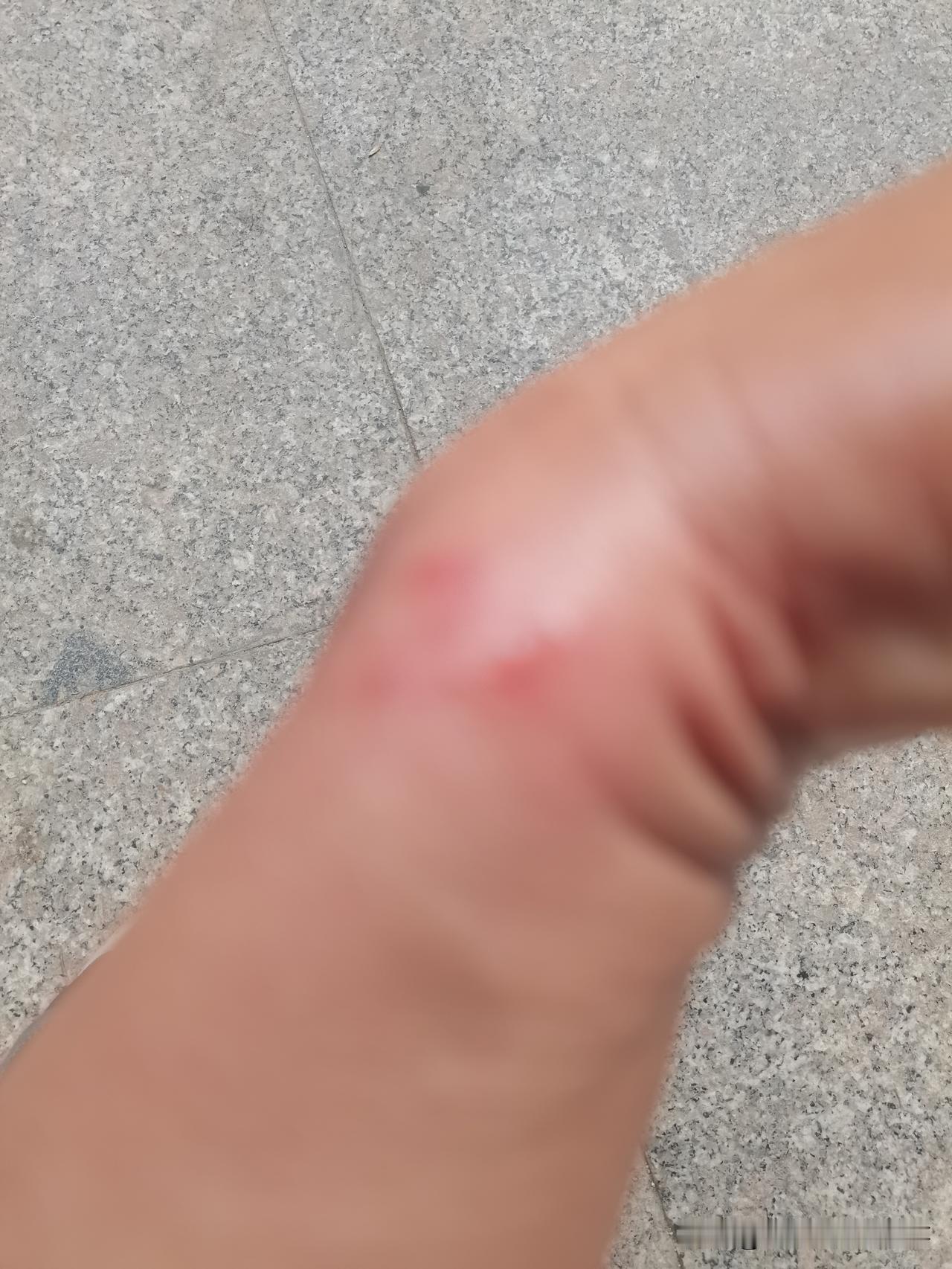 被无花果伤到了。
昨天分拣无花果的时候，忘了戴套袖，无花果汁液弄到手脖子上了。