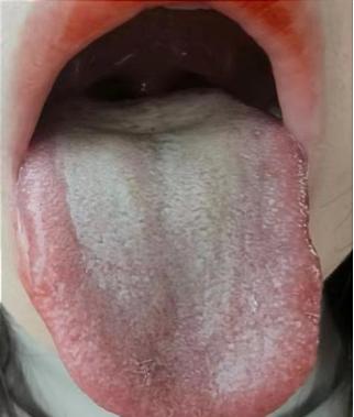 看这个舌象，虽然肝郁脾虚，但也不能直接吃逍遥丸，相当于火上浇油
因为，这种舌象，