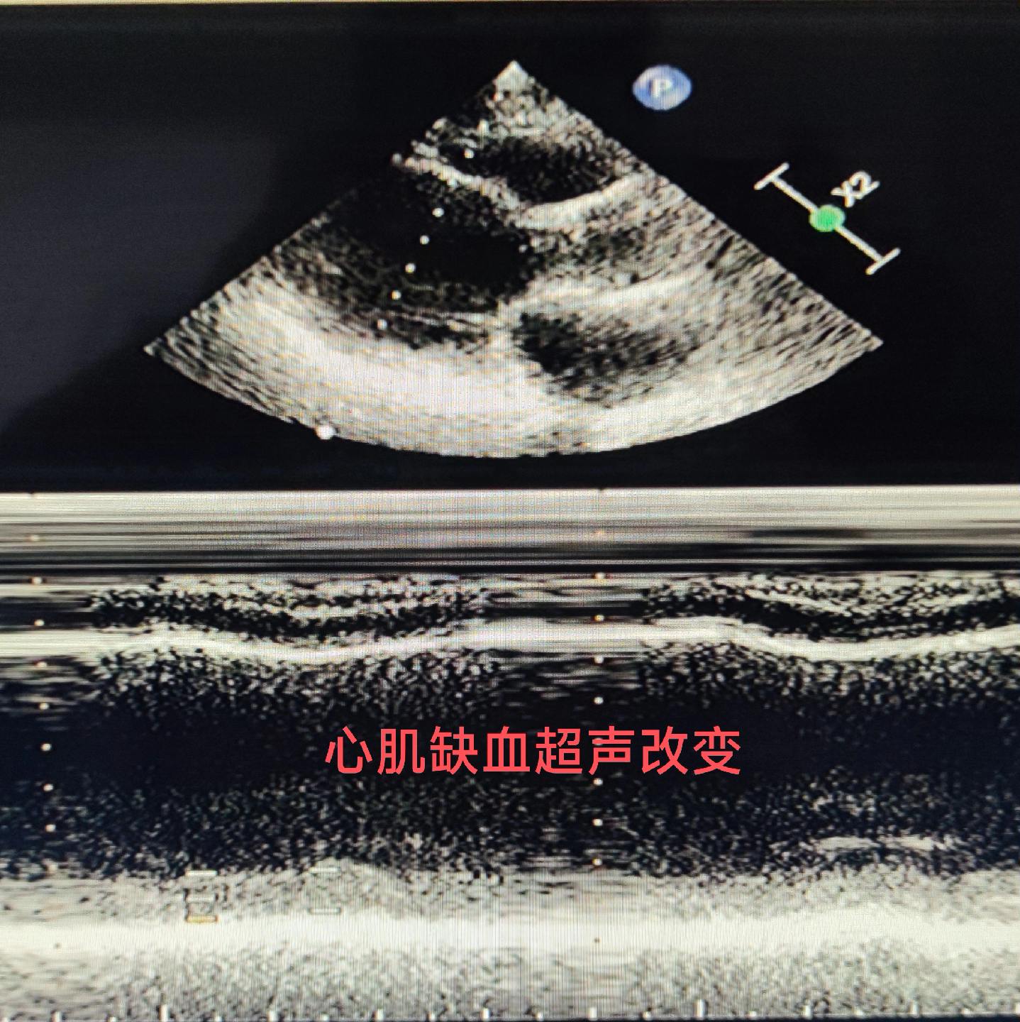 心肌缺血超声改变。室间隔变薄，运动幅度明显减弱
与DSA及心电图对照
DSA前降支远段狭窄99%