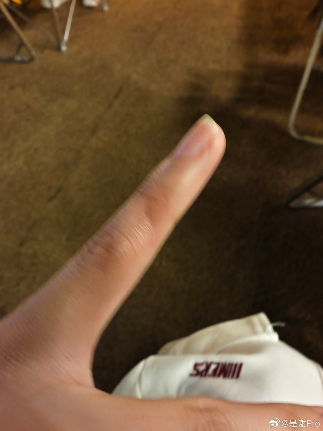 长期用小拇指托手机的后果你是说这样子吗？已经有个坑印了   我的小拇指已经习惯当