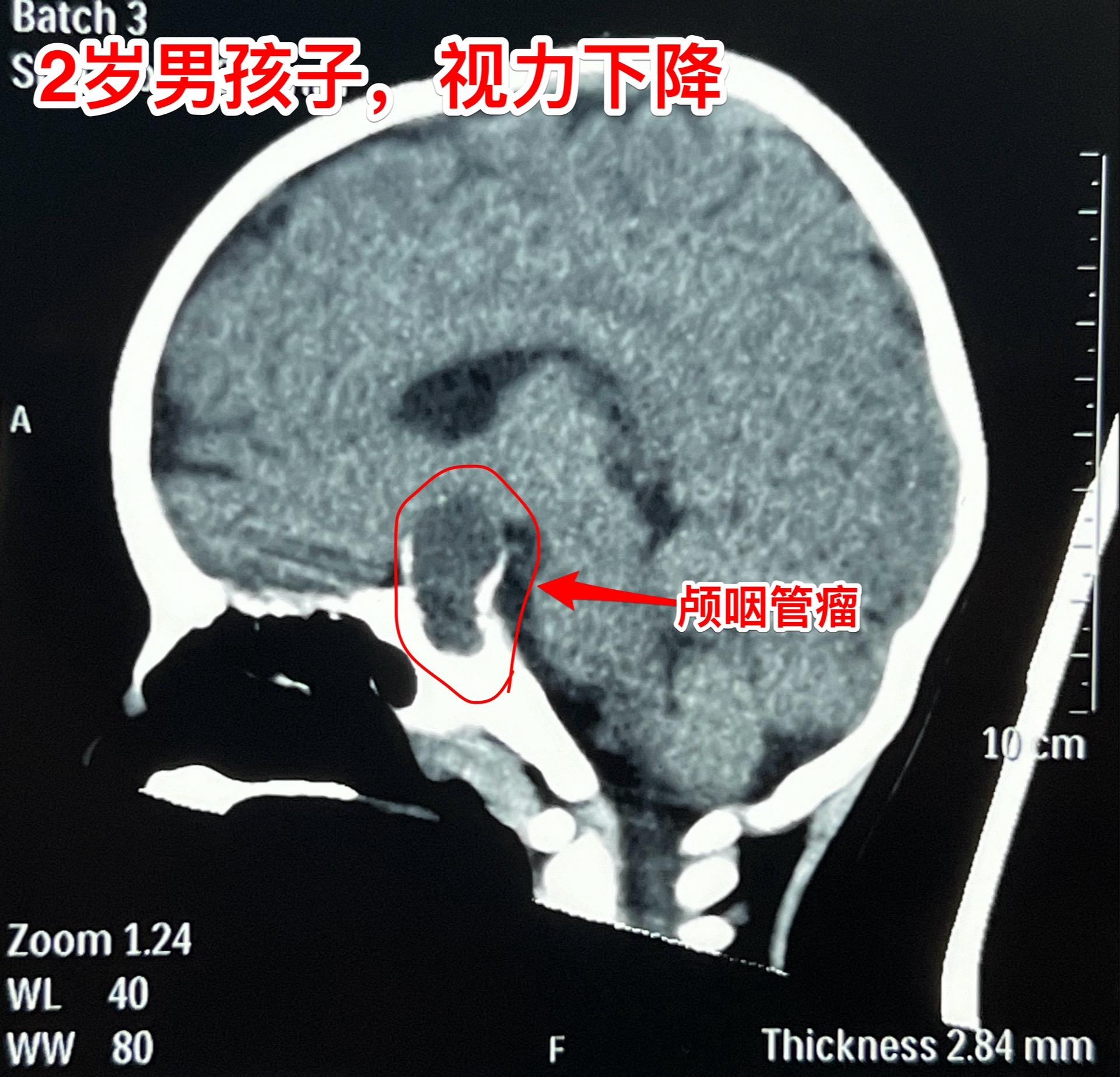 老天造孽哦，才2岁的孩子就患上颅咽管瘤。CT和磁共振显示是典型的颅咽管瘤，有钙化。视神经受压，视力有下降（还没有到失明的程度），不得不接受手术治疗。5月11日顺利将肿瘤完全切除。希望肿瘤不复发。