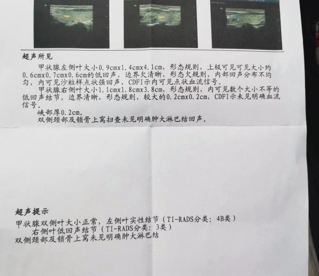 甲状腺乳头状癌消失了，3年前发现小的乳头状癌，不愿意手术切除，选择了消融。想告知