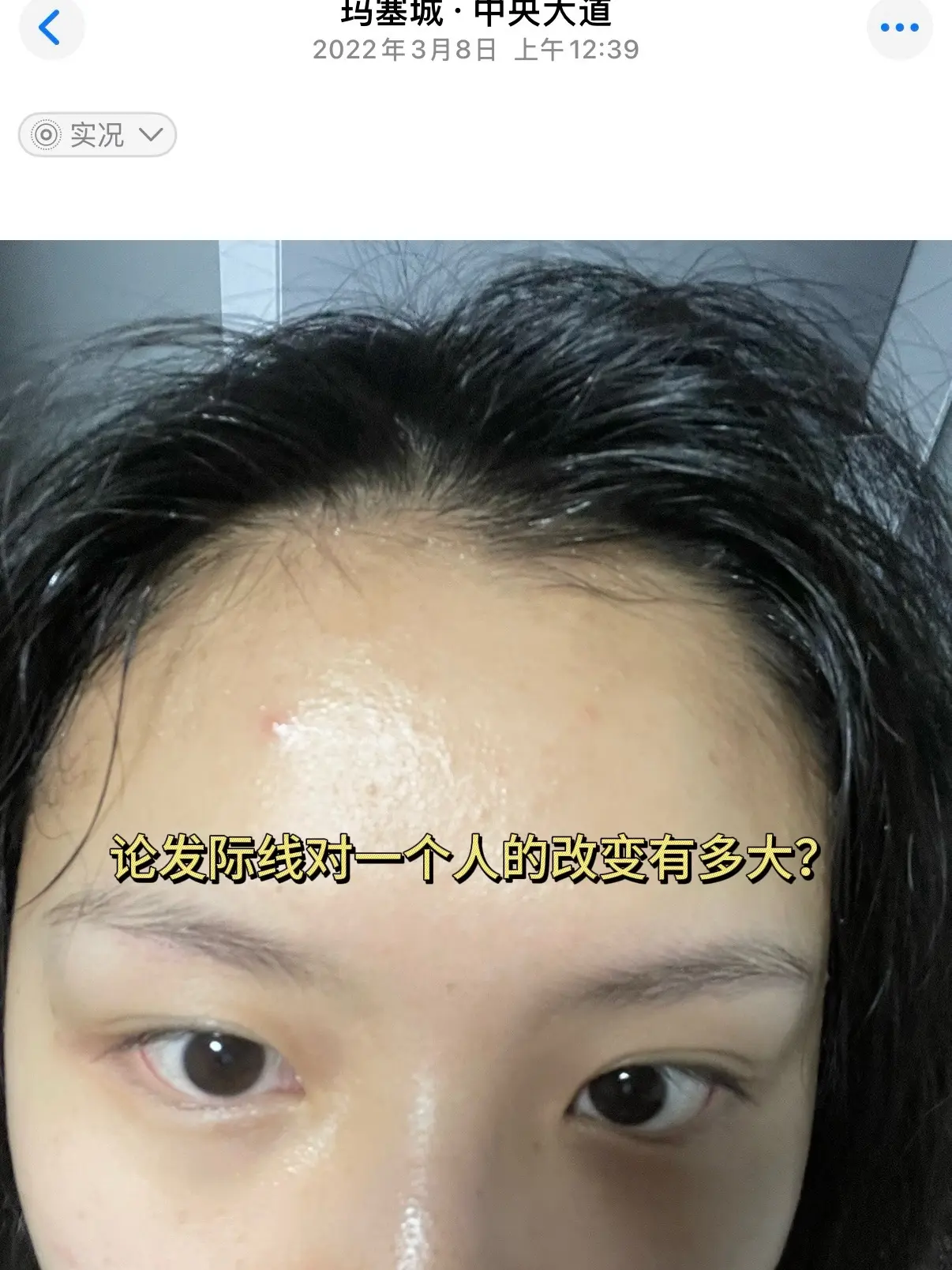 关于我的发际线养护经历： 上学时因为压力大、饮食不规律，发缝越来越宽...