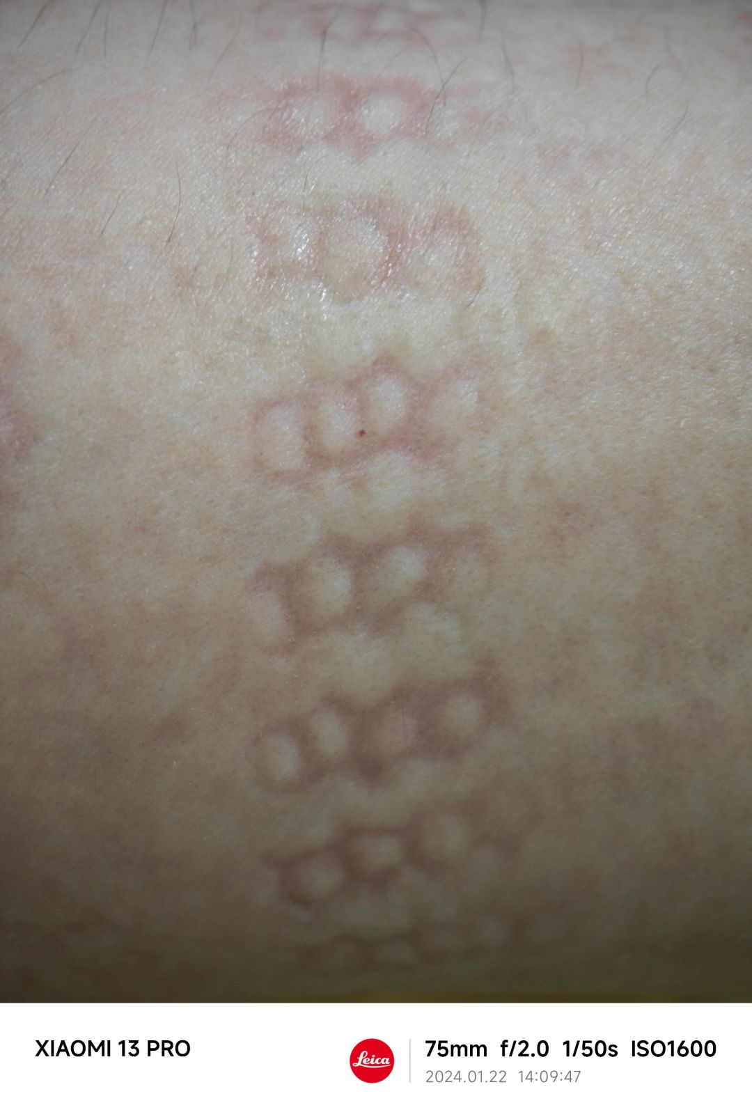 NO.372 盘珠子起疹子了