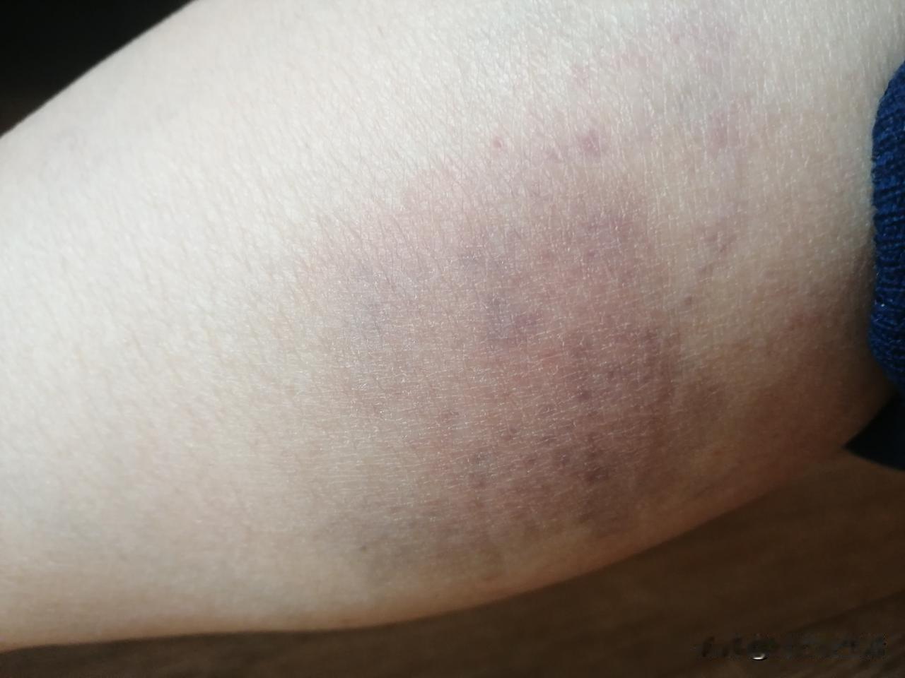 腿疼就是堵了，猛敲一顿好了
这几天左腿肚子疼，疼的晚上睡不好觉，昨天看到门后边的