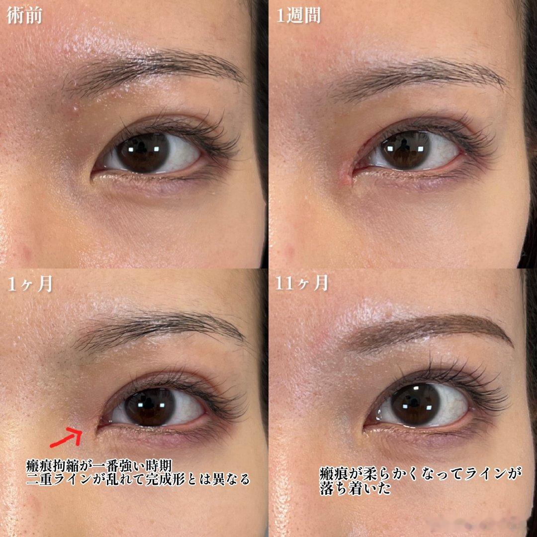 刷到这个做了上眼角内眼角调整眼角形态的案例，医生想保留眼角勾的特色，但我觉得这个