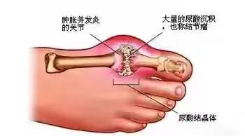 痛风是一种让人痛苦不堪的疾病，但是你知道吗？有一种神奇的中药方可以帮到你！那就是