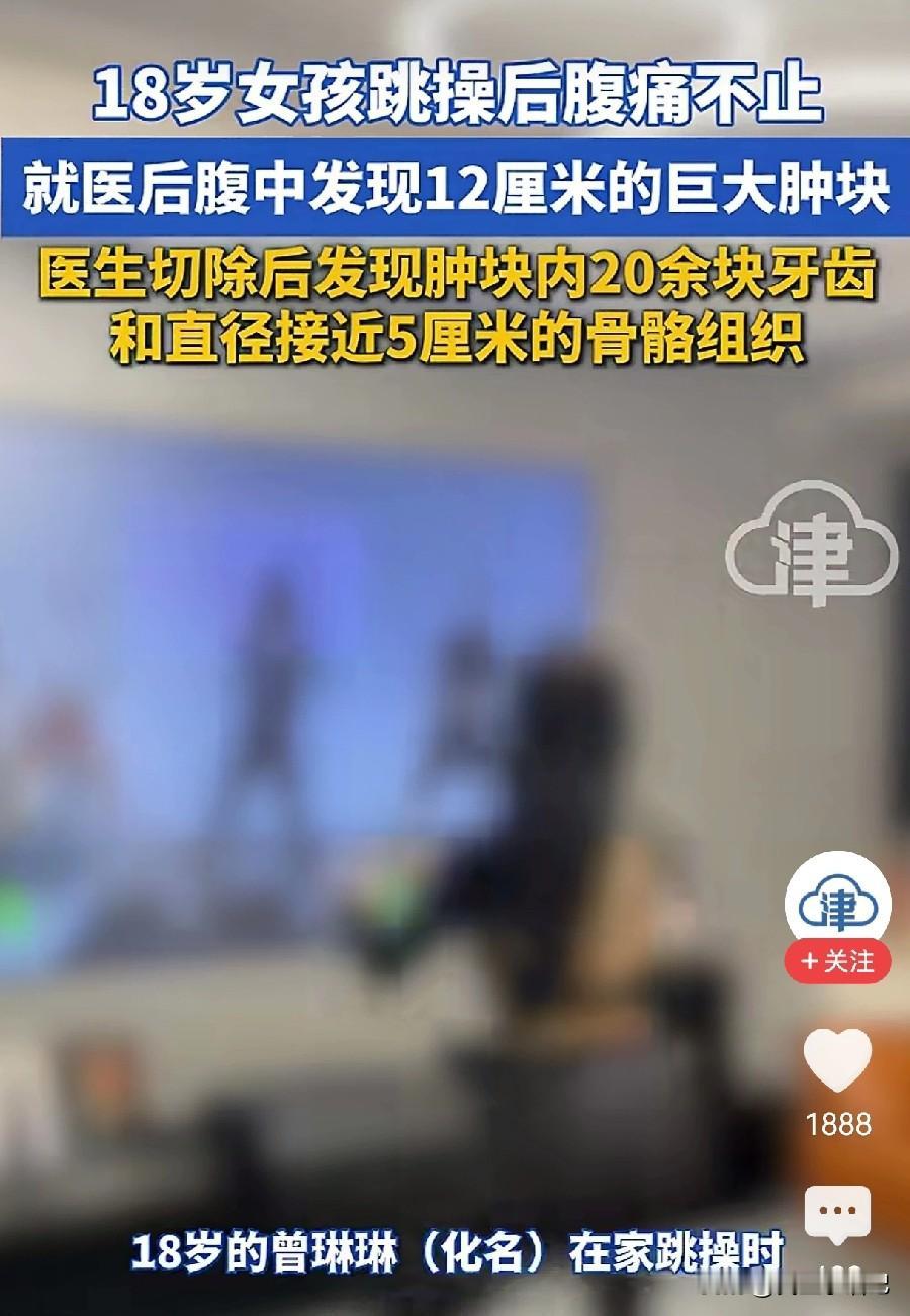 18岁女孩跳操突然腹痛，医生竟从肚子里取出“牙齿”！这20多颗牙齿到底哪来的？