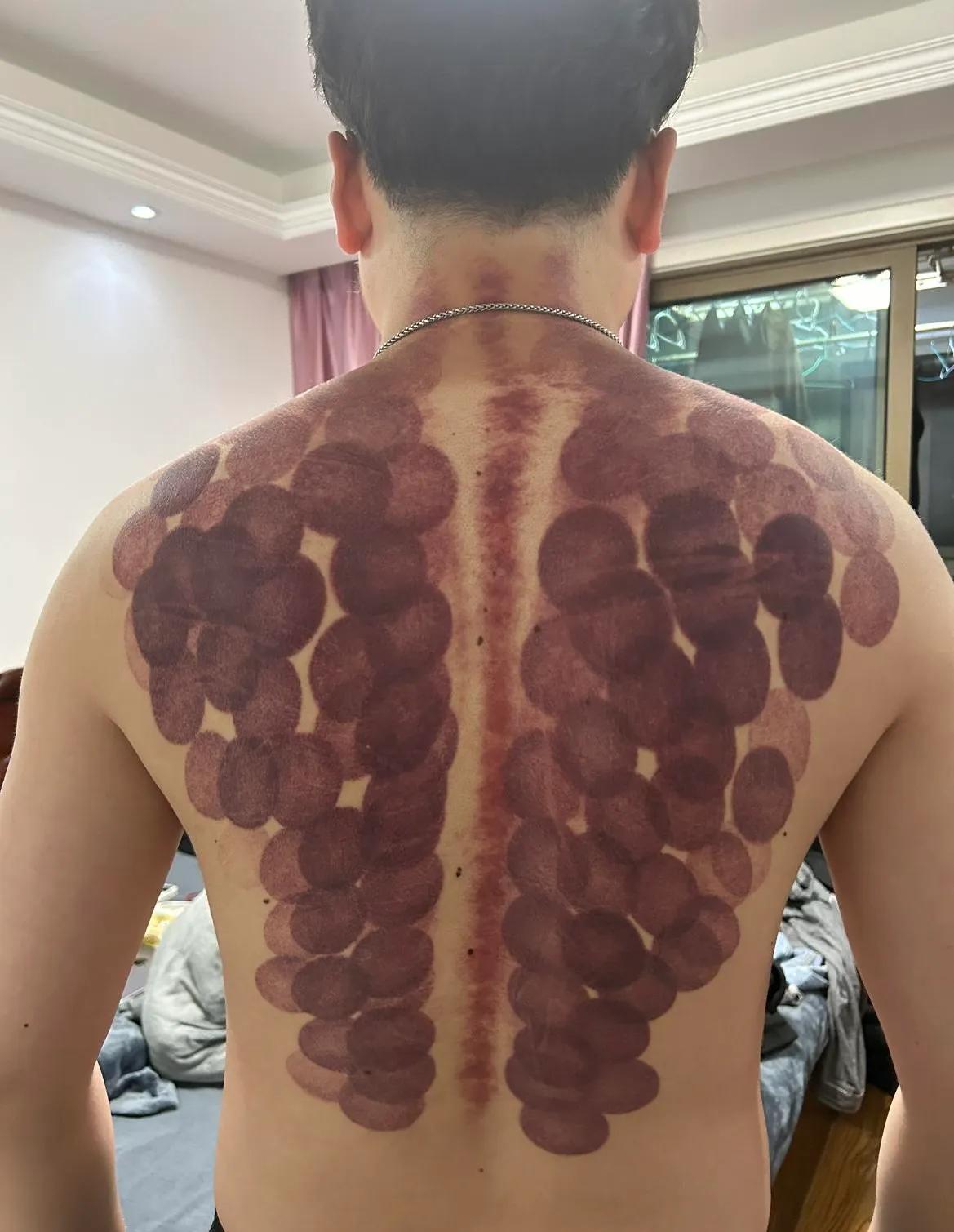 湿气重要多拔罐 这湿气也太重了