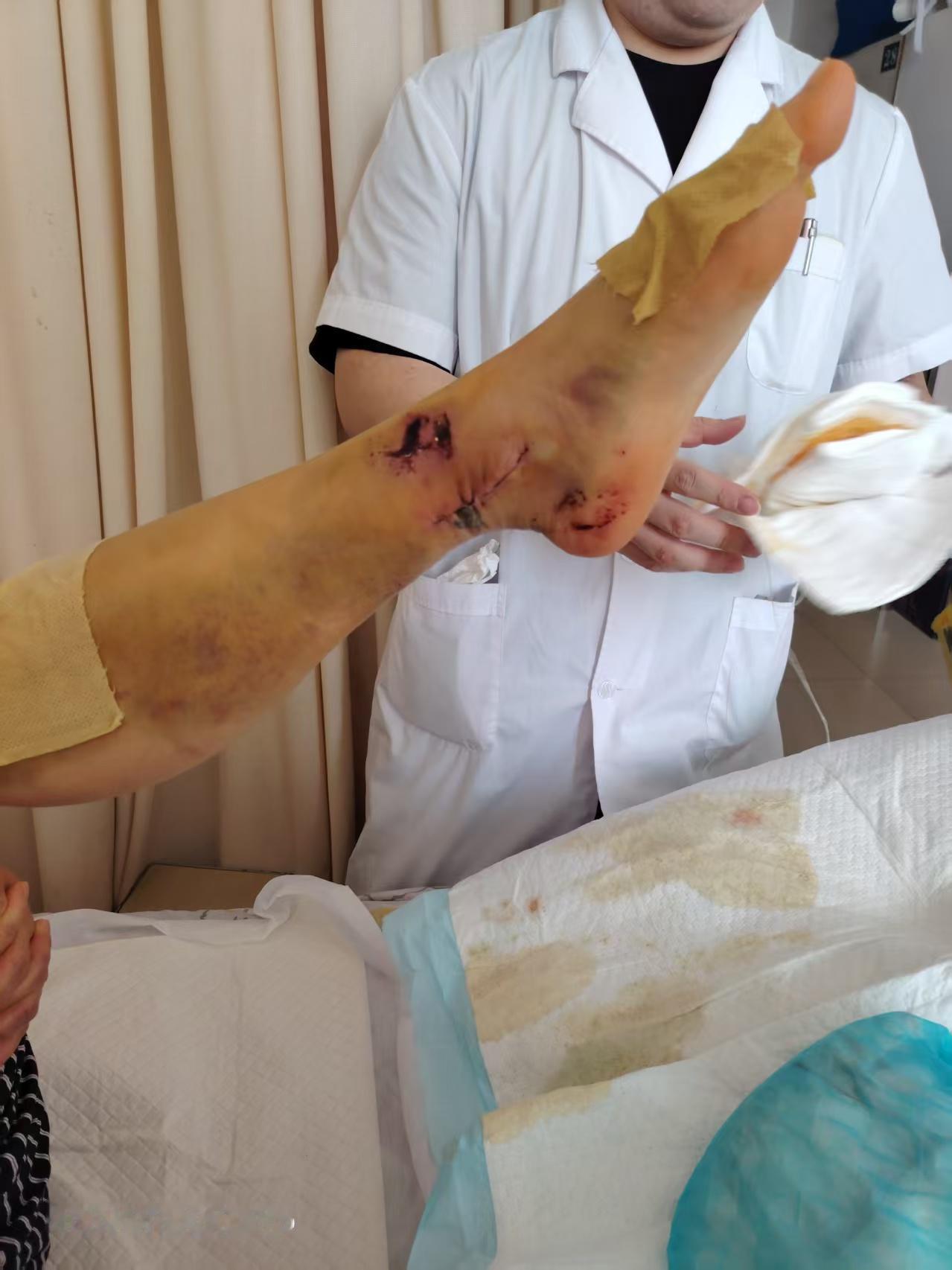 天塌了。
      儿媳妇滑板追求新造型脚踝二处错位，三处骨折，在郑州骨科医院