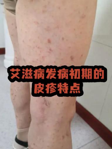 艾滋病隐瞒不了了。据说重庆、云南、广东、广西等多地接连出手，通过地方立法把艾滋病