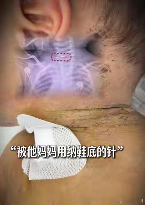 一个婴儿的悲惨遭遇，撼动了无数人的心《又是精神病！10月大婴儿被母亲扎500个针