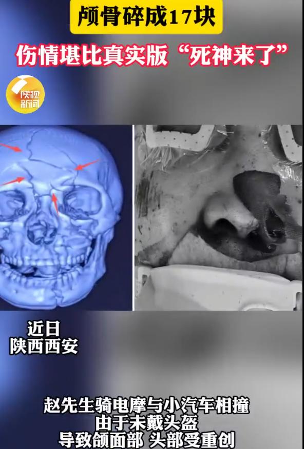 [谢谢]“一念侥幸险丢命！”陕西西安，男子骑电摩与汽车迎面相撞，因未戴头盔，致颅
