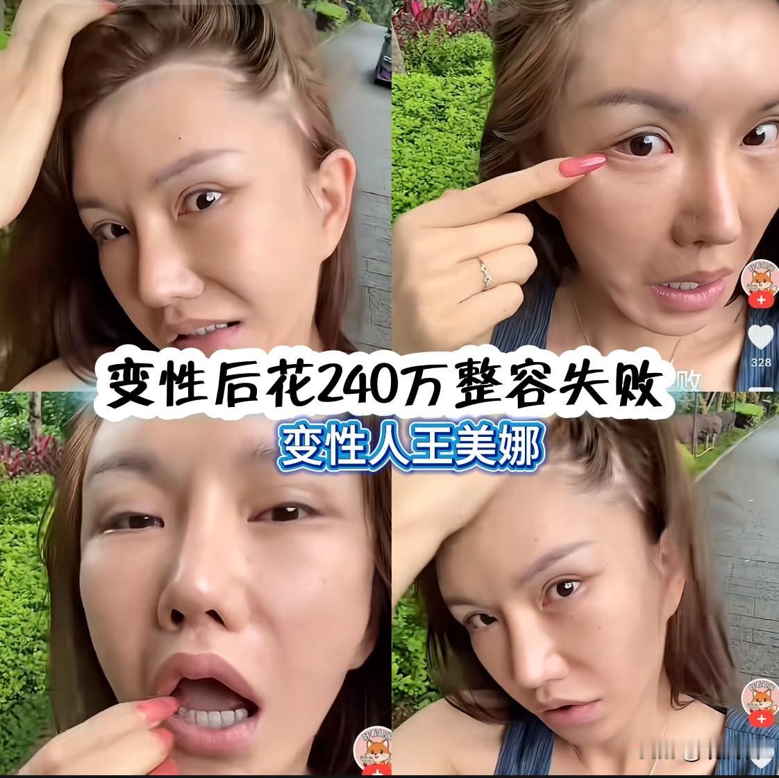 变性人王美娜花240万元整容失败。
王美娜是个男人，他早年去泰国做了变性手术，变