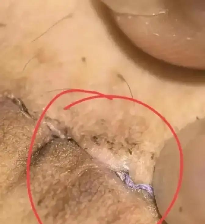 剖腹产第17天洗澡，刀口突然崩开，黑线头直接翘出来，产妇当场吓懵，拍照发群里想靠