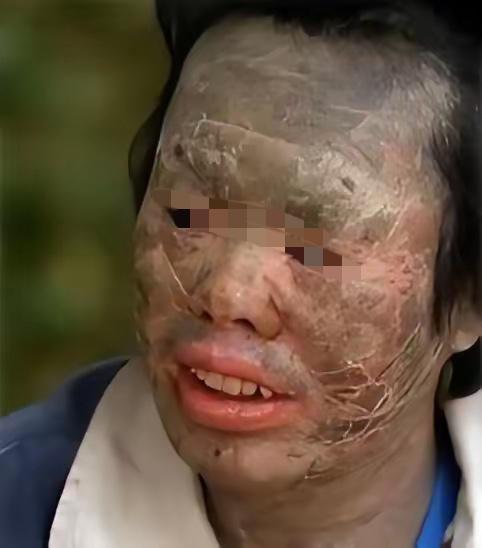 吃蛇竟吃出“蛇皮身”？辽宁这位村民的经历，真的给所有人敲响警钟！

韩永波常年爱