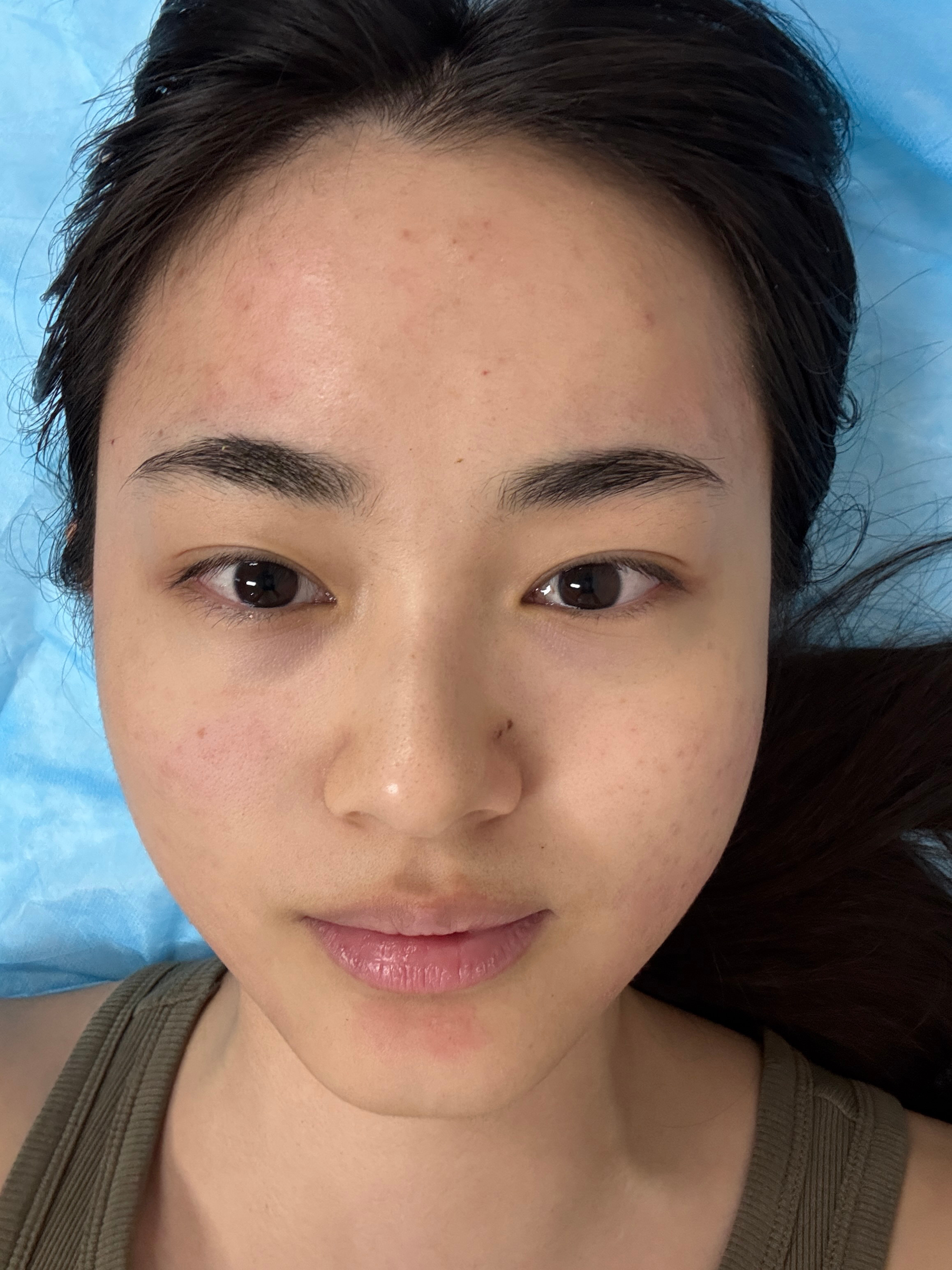 皮肤稳定后针清也没那么红了图1针清前图2针清后我这个脸躺下直接摊开 笑鼠 朋友说