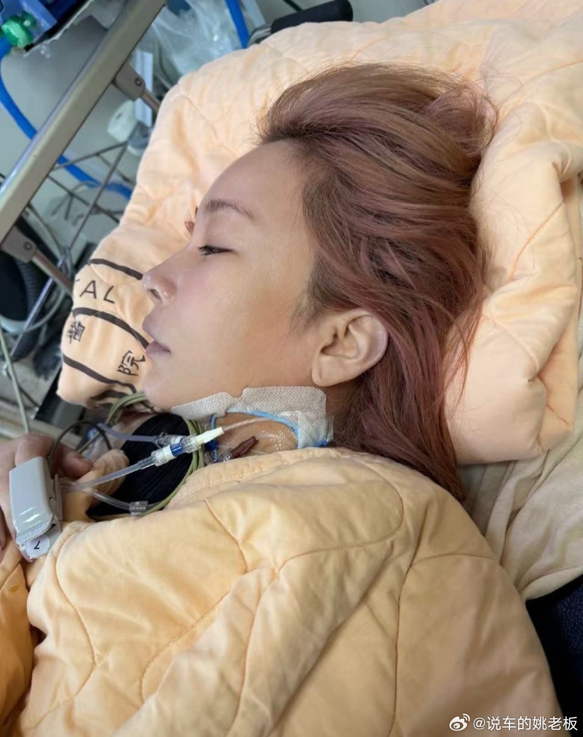 今日，歌手温岚经纪人报平安：因结石引发败血症致败血性休克，5月14日紧急入ICU