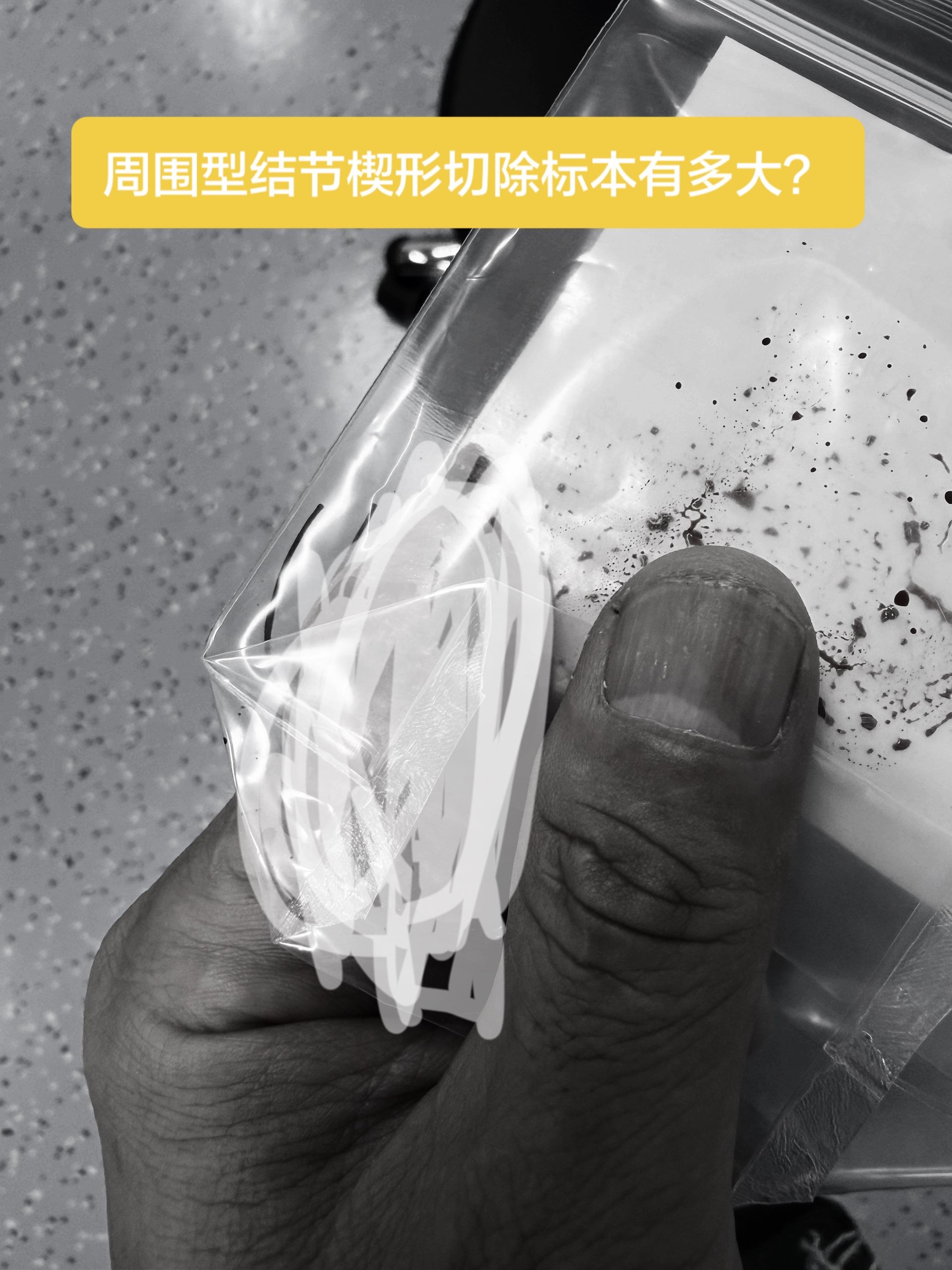 符合肿瘤学原则的前提下满足他的心愿……这位小伙子术前反复跟我要求切少一...