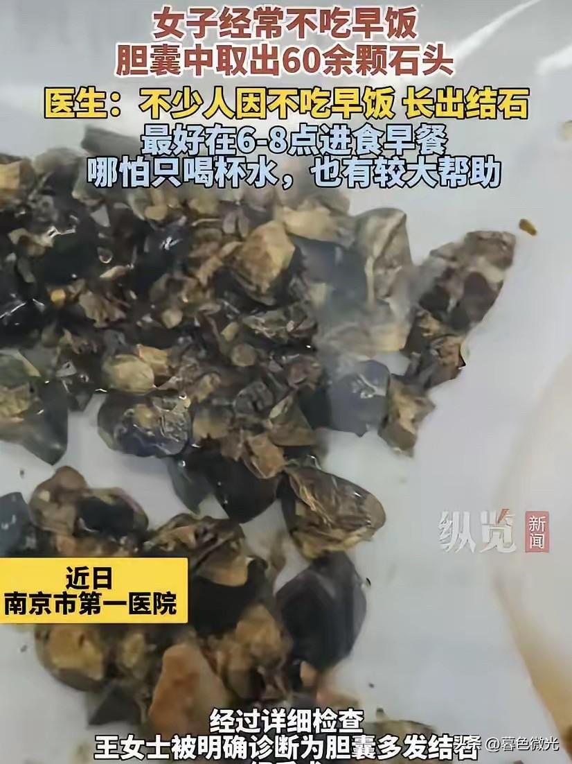 太吓人!南京35岁女子聚餐后肚子剧痛，去医院一查，医生从她体内取出这玩意儿。
