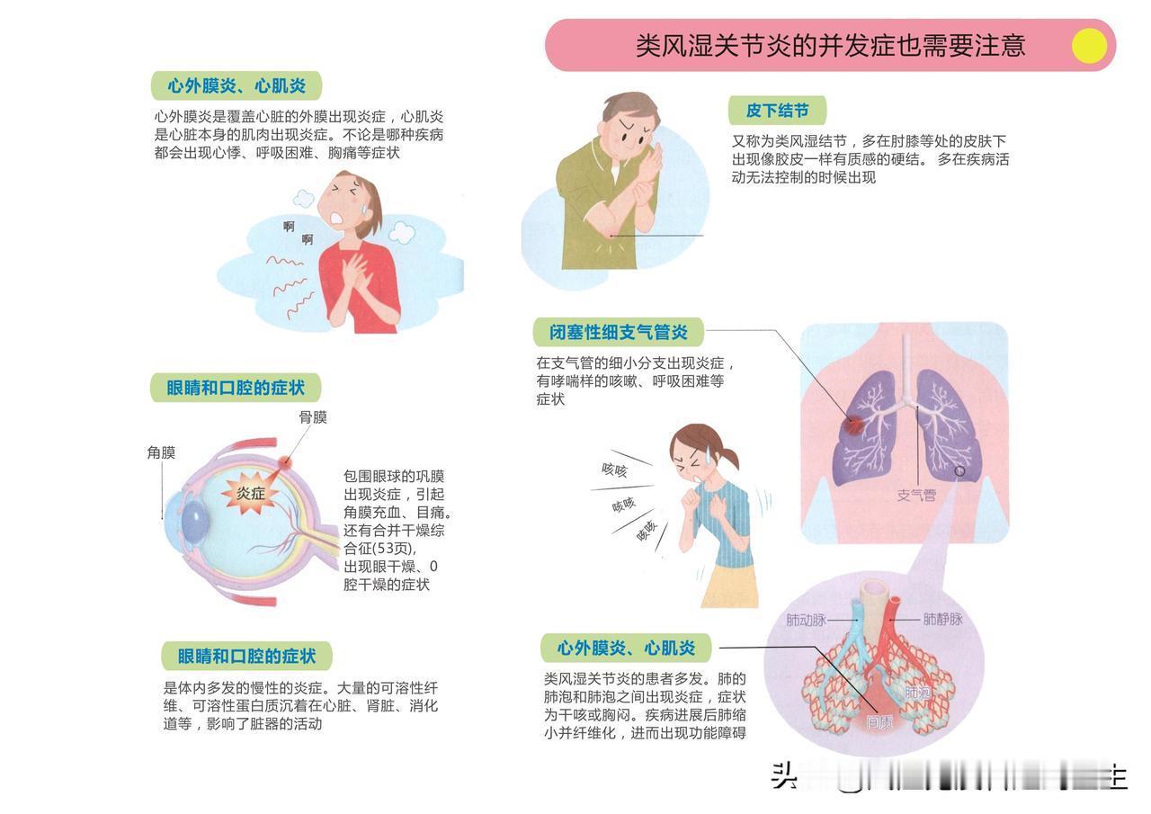 什么是恶性类风湿关节炎？#类风湿病#

类风湿关节炎一般表现为关节受累，但实际上