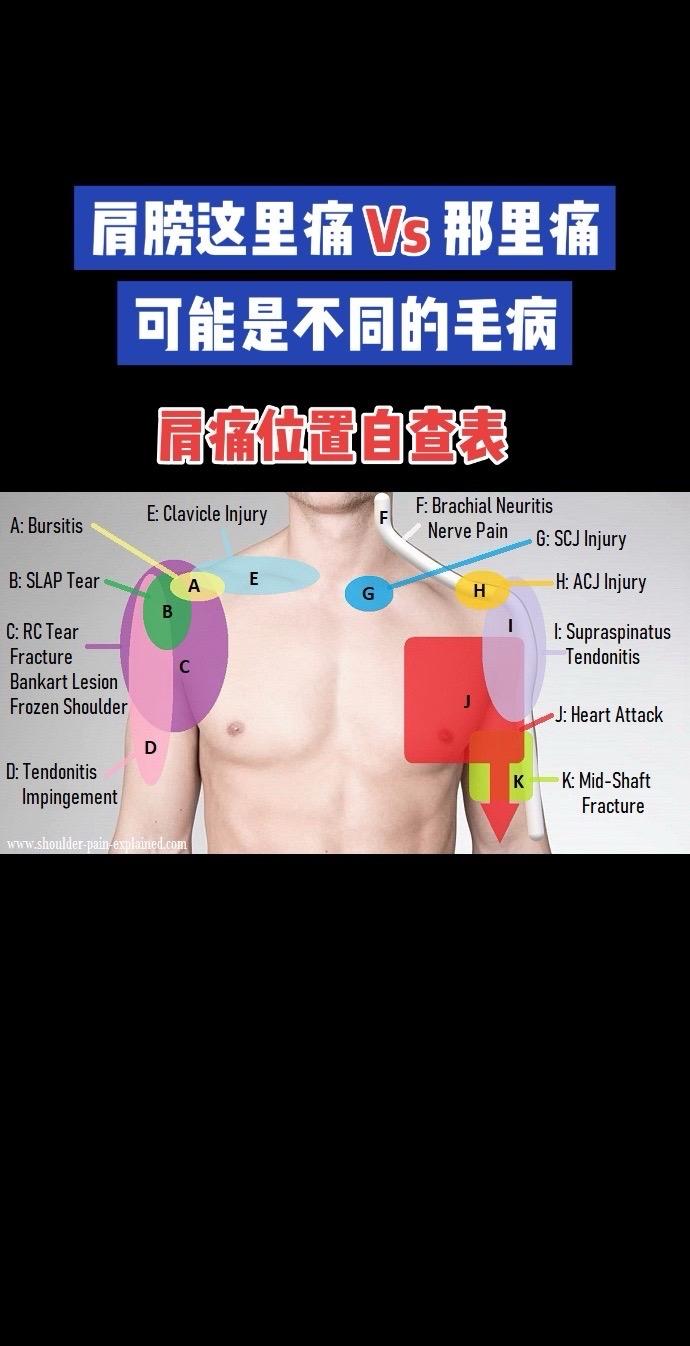 肩关节痛图。肩膀痛位置不同，病根完全不同！快看你是哪一种？💡运动医学