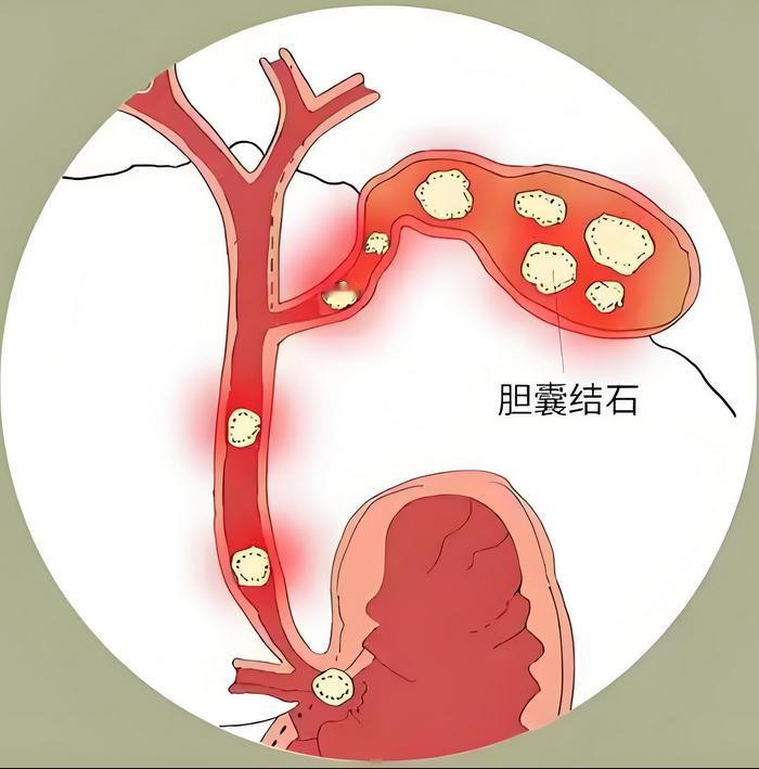 胆结石发作的警报，藏在腹部变化里，多数人都忽略了
 
不少人以为胆结石痛起来突然