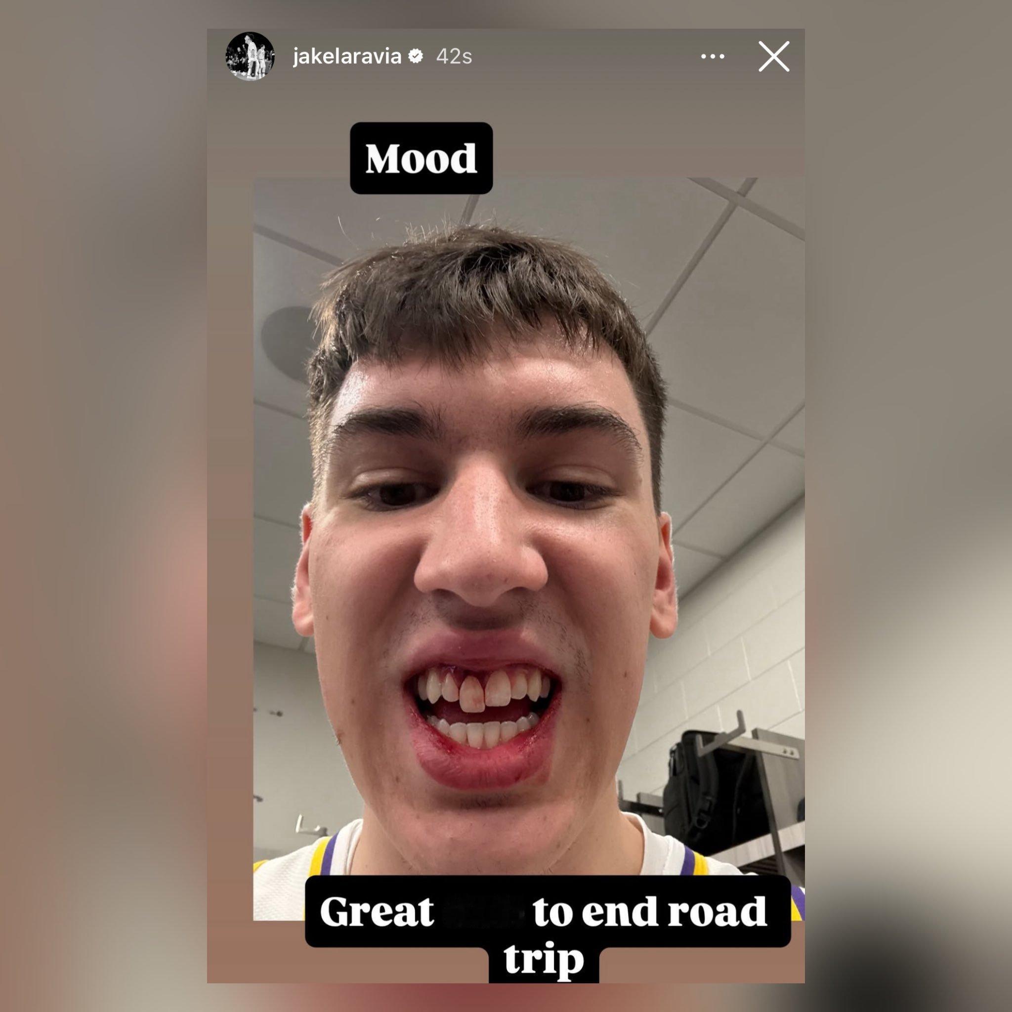 拉拉维亚更新IG，牙掉了。洛杉矶湖人湖人vs76人