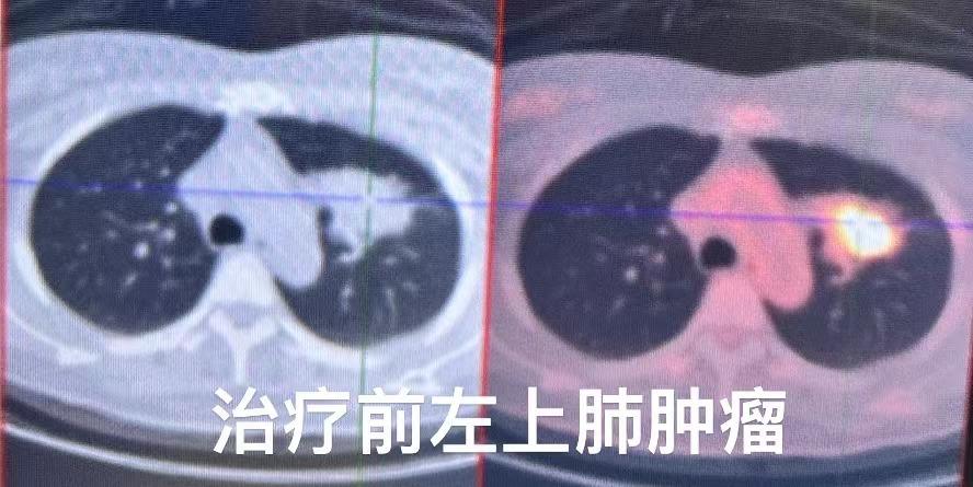 我到现在还记得，他听到“晚期肺癌”这四个字时，眼神里瞬间涌出的惊恐和无助。他当场