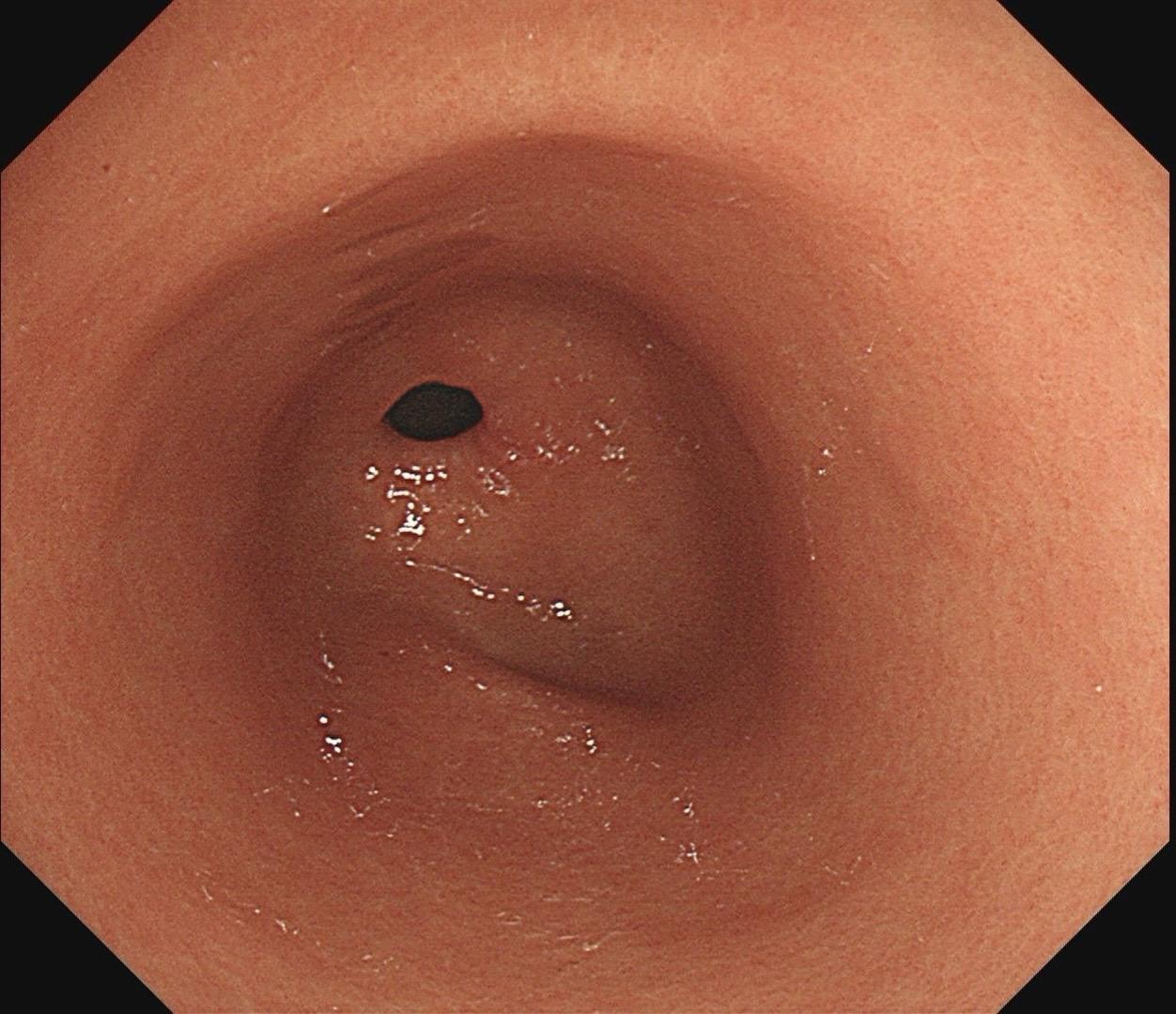 女，67岁，胃双发微小褪色调病变。慢性胃炎复查，平时无明显不适。Hp阴...