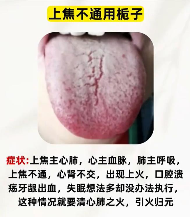 三焦不通体虚缠身，结合舌象看懂脏腑气机阻滞表现